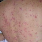 Chikungunya