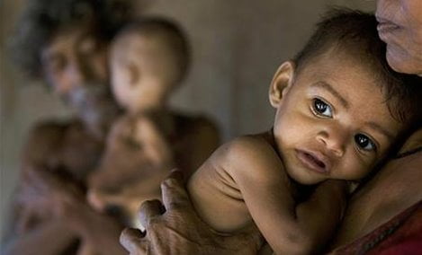 Rohini e Rohit, due gemelli indiani malnutriti, a Mumbai.