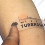 Tubercolosi