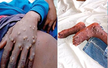 monkeypox