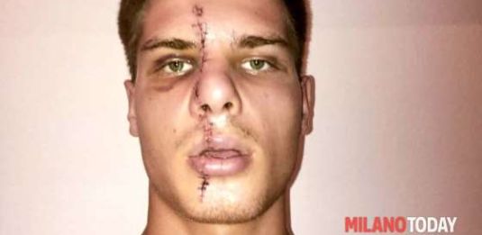 Milano, ragazzo sfregiato e rapinato