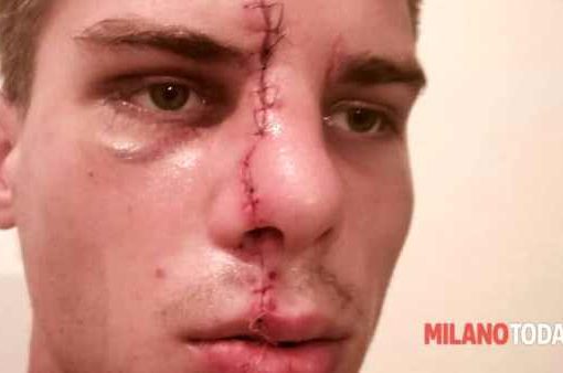 Milano, ragazzo sfregiato a vita: condannati 5 nordafricani ragazzo sfregiato