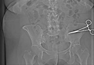 Chirurgo dimentica forbici nell'addome della paziente