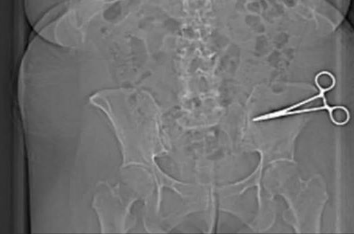 Chirurgo dimentica forbici nell'addome della paziente