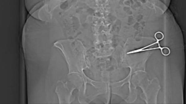 Chirurgo dimentica forbici nell'addome della paziente