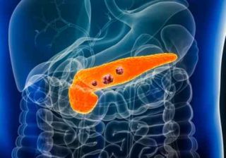 cancro al pancreas