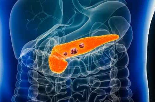 cancro al pancreas